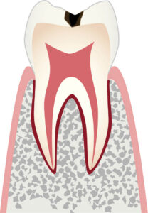 エナメル質（歯の最表層）に限定したむし歯