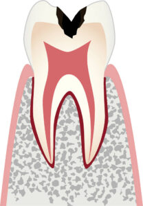 象牙質（歯の内部）まで到達するが、歯髄にまでは及んでいないむし歯
